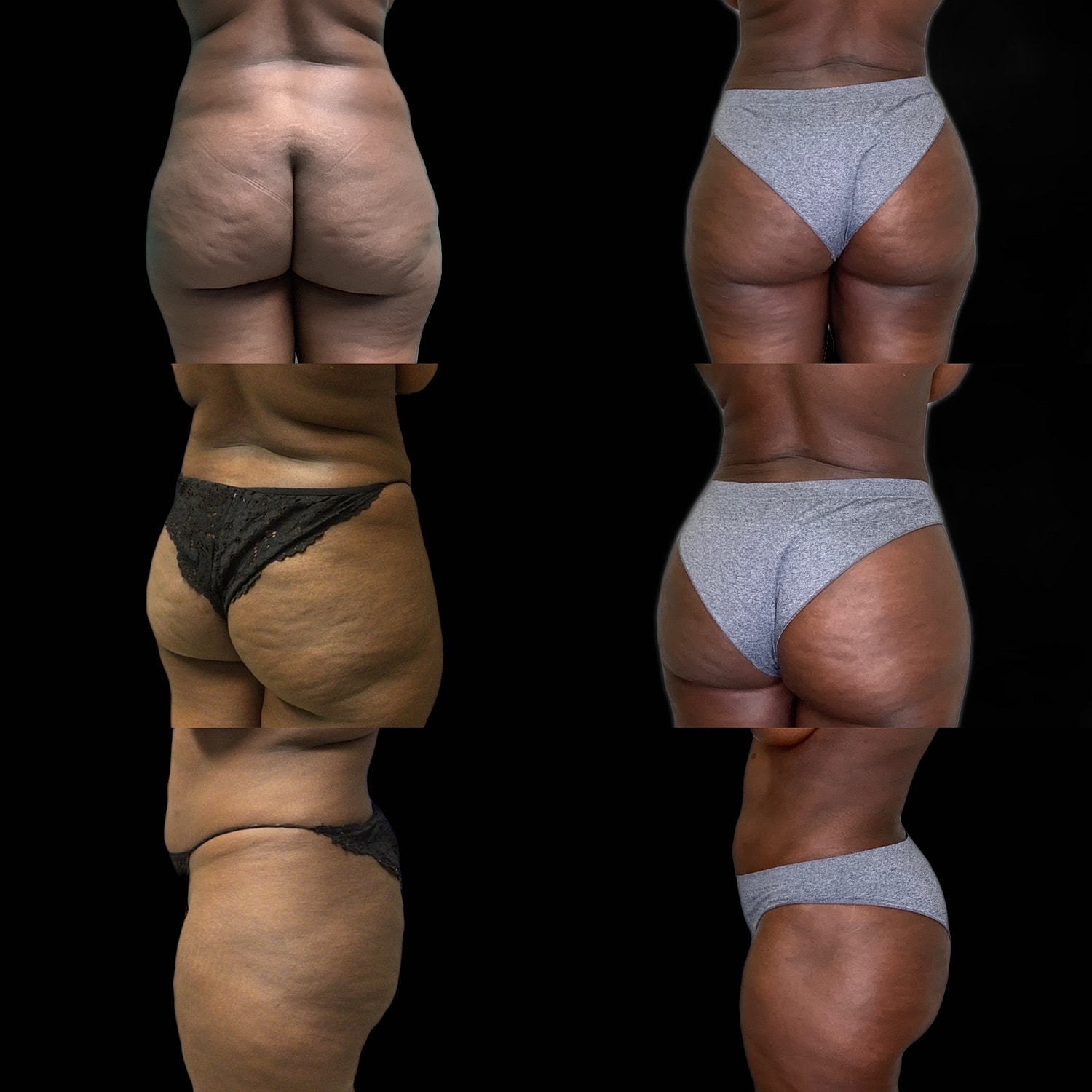 BBL - Fat Transfer Gallery Before & After