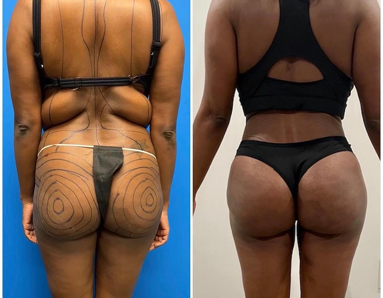 BBL - Fat Transfer Gallery Before & After