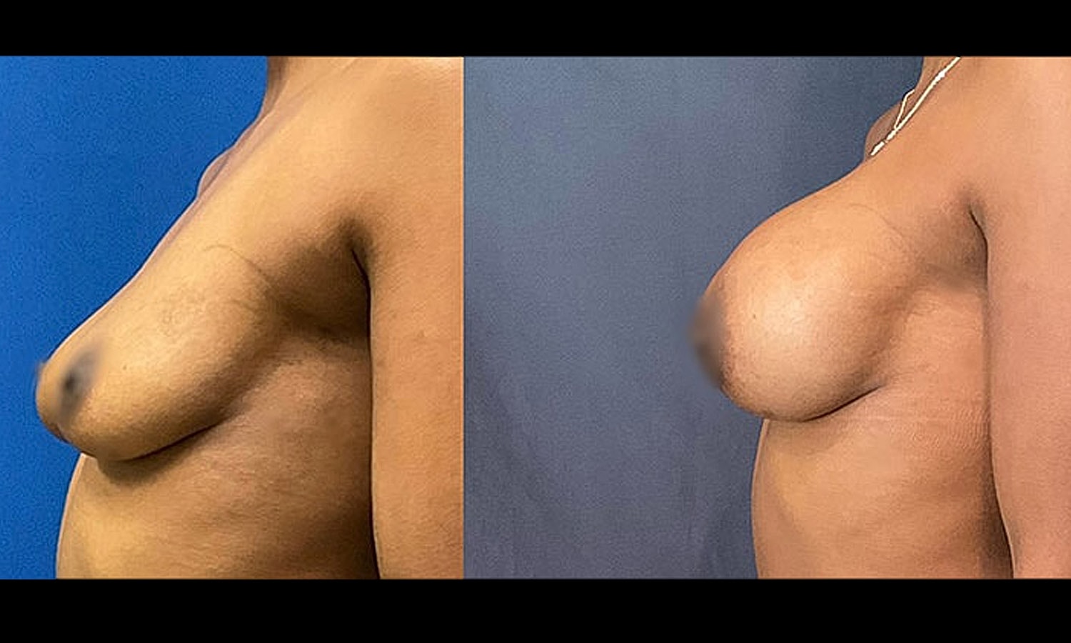 Breast Augmentation Gallery Before & After