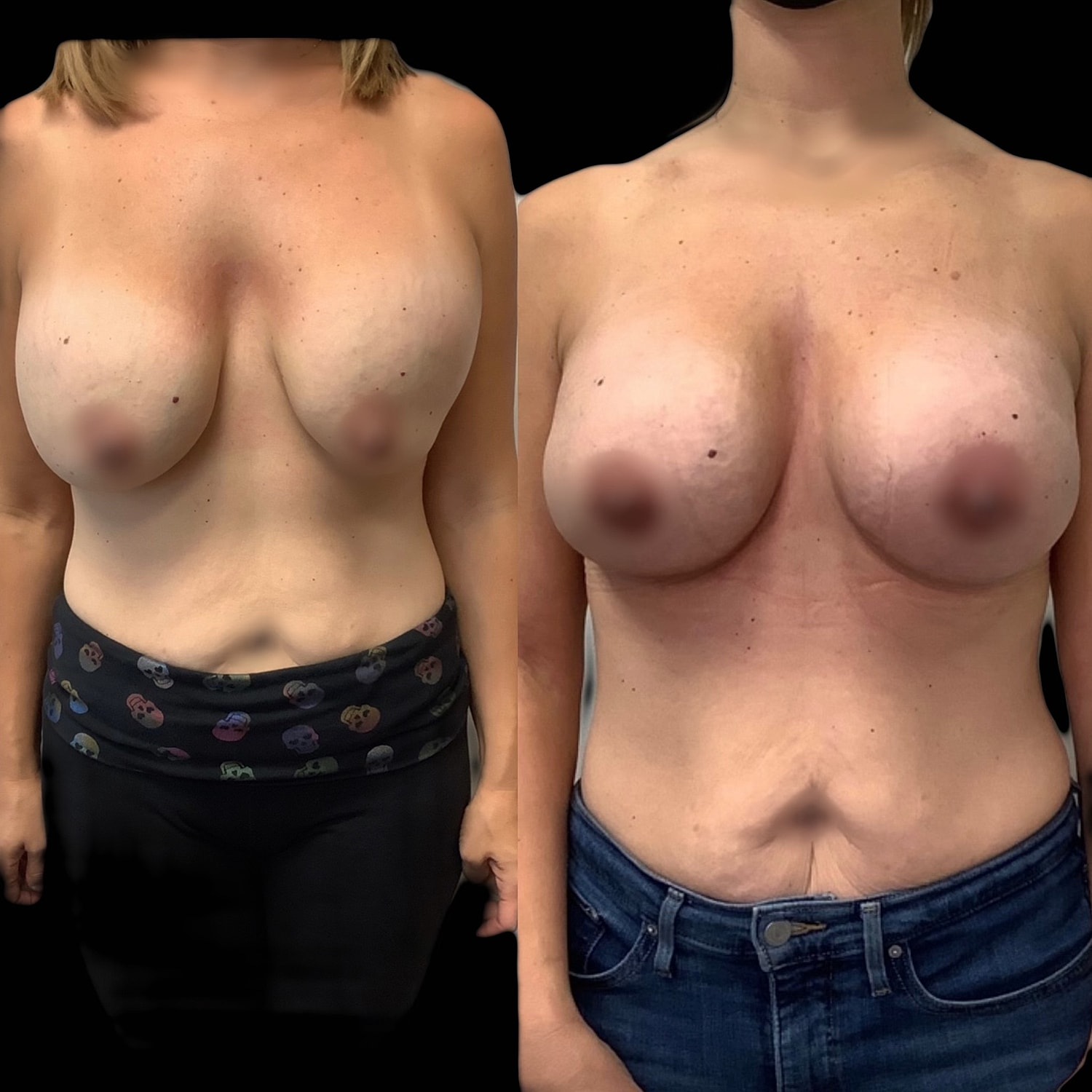 Breast Revision Before & After