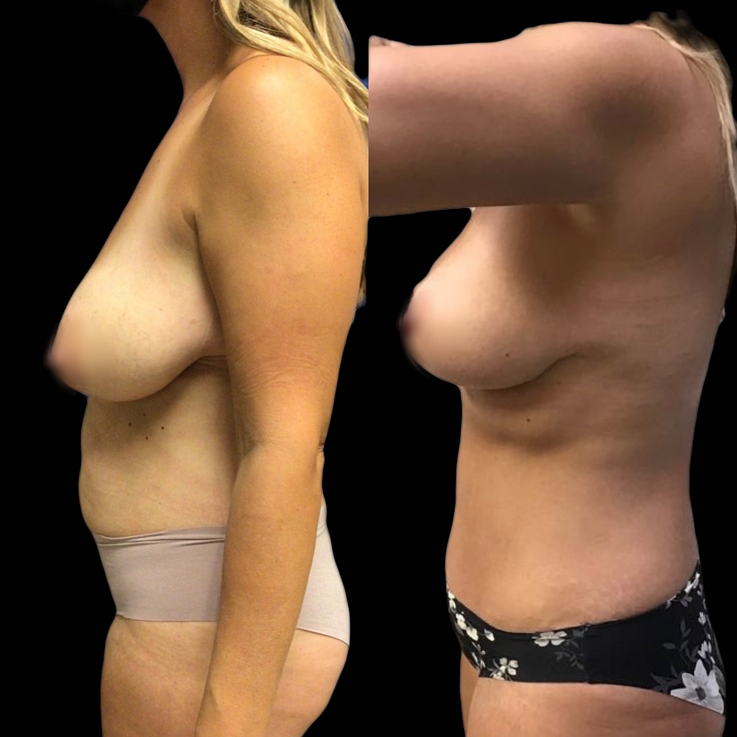 Mommy Makeover Gallery Before & After