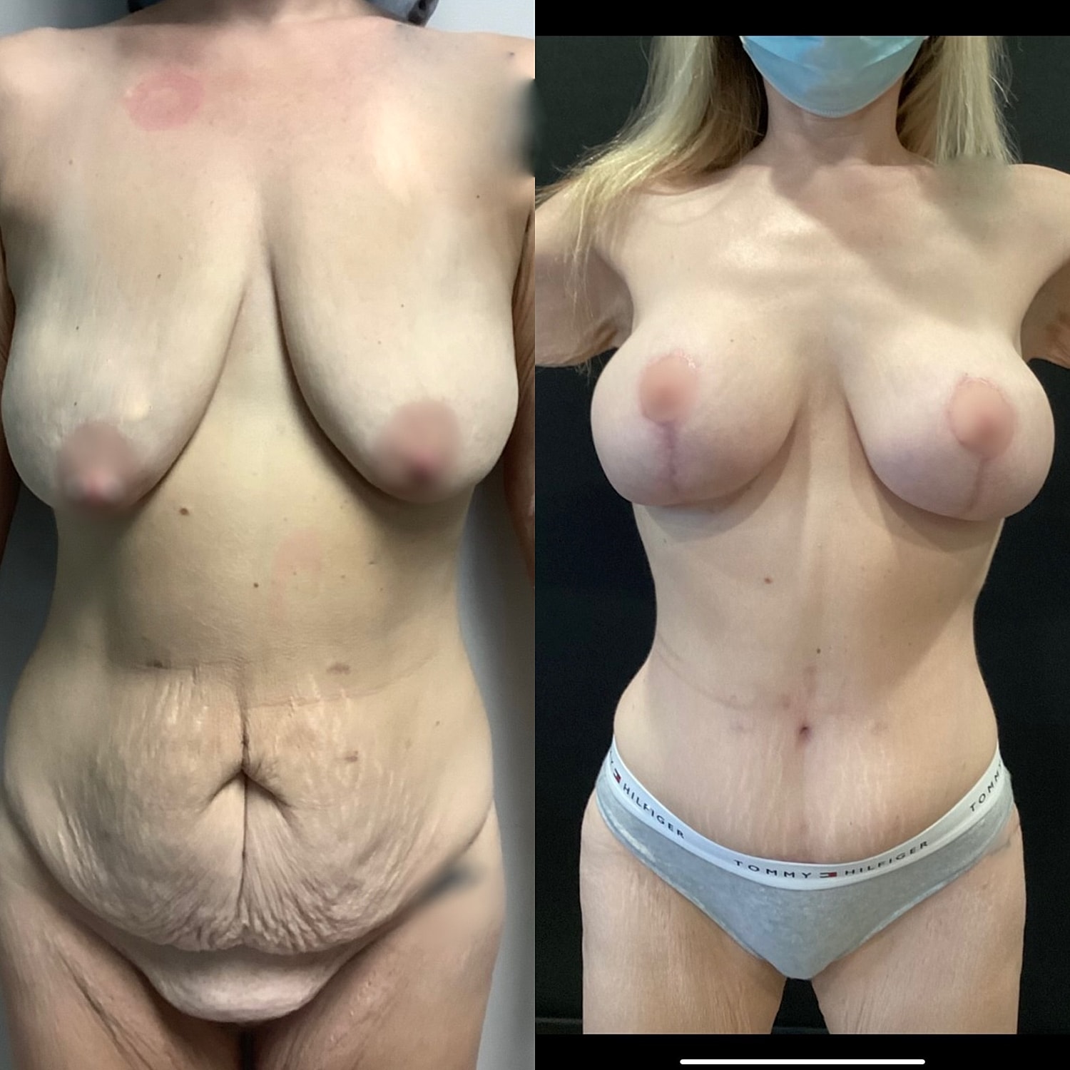 Mommy Makeover Gallery Before & After