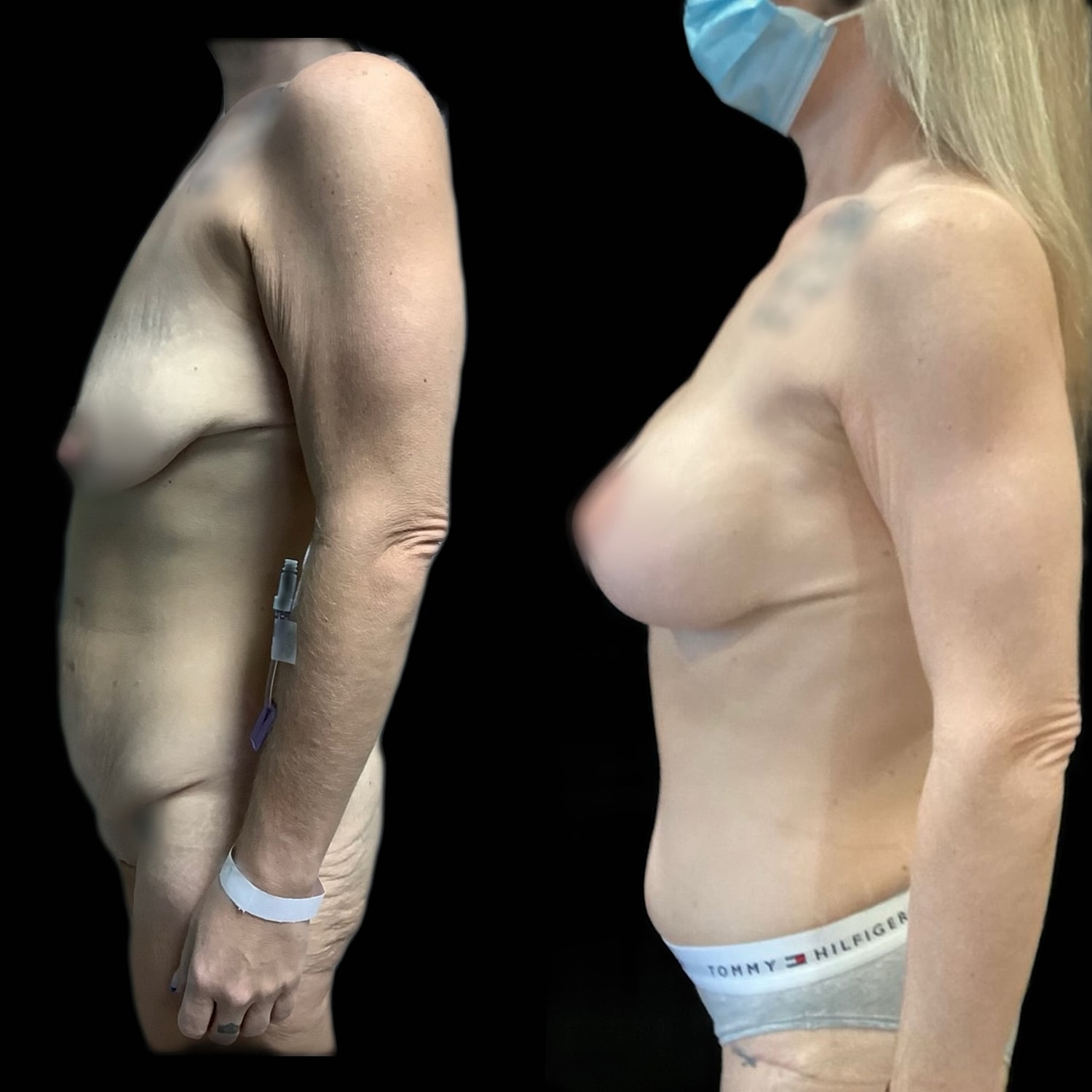 Mommy Makeover Gallery Before & After